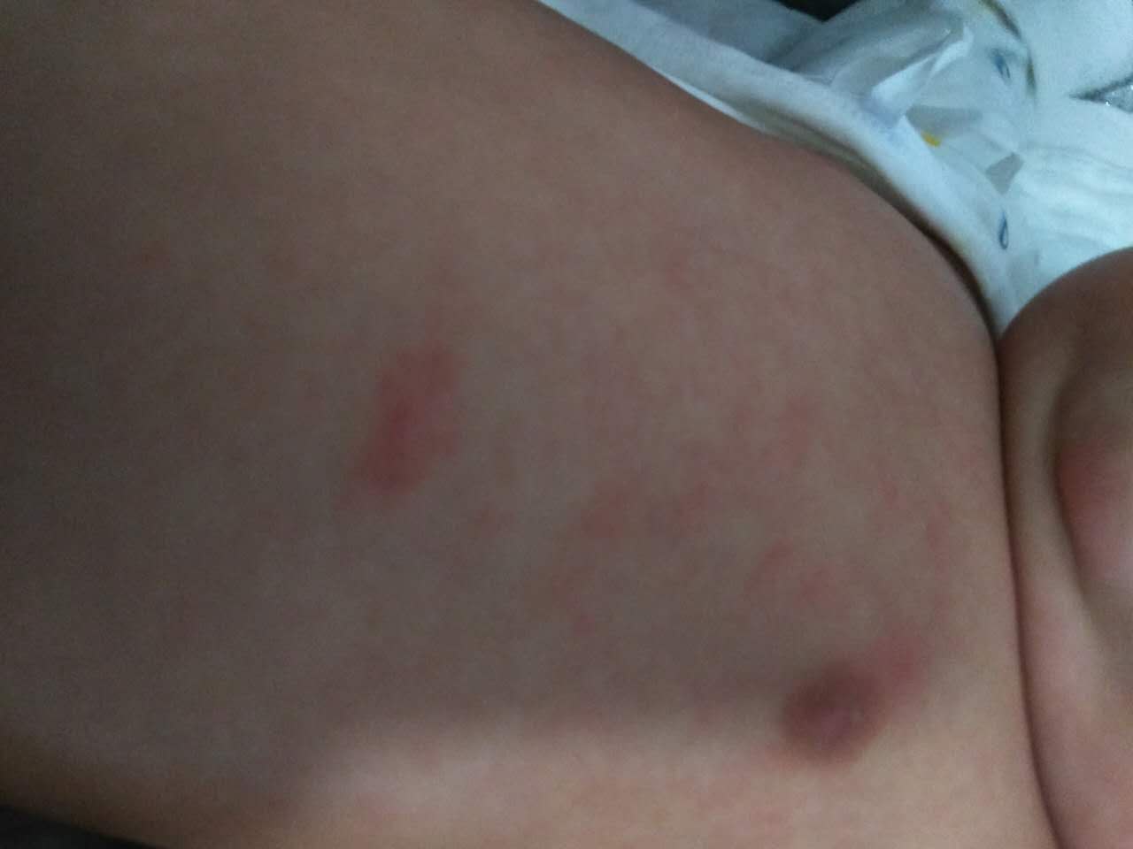 宝宝湿疹反反复复要怎样改善呢,宝宝湿疹反复发作难治愈