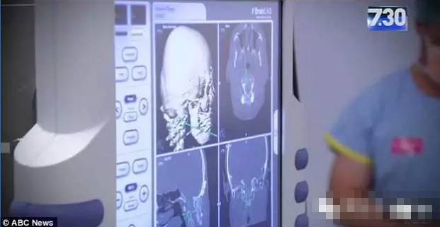 Sun资讯速递澳洲医学再次震惊全宇宙！澳洲医生完成全球首例人头分离手术！罕见癌症就这么治好了！