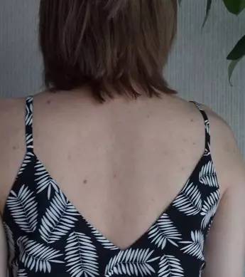 第二天要穿吊带如何解决背后痘痘,后背有痘痘穿吊带的急救办法