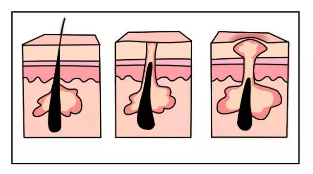 这可能是夏天穿吊带最大的烦恼……这可能是背部痘痘最全攻略