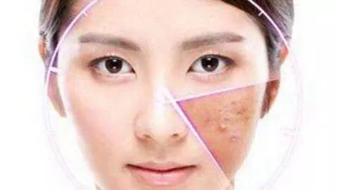 激素依赖性皮炎禁忌吃什么,激素依赖性皮炎干燥脱皮怎样护理