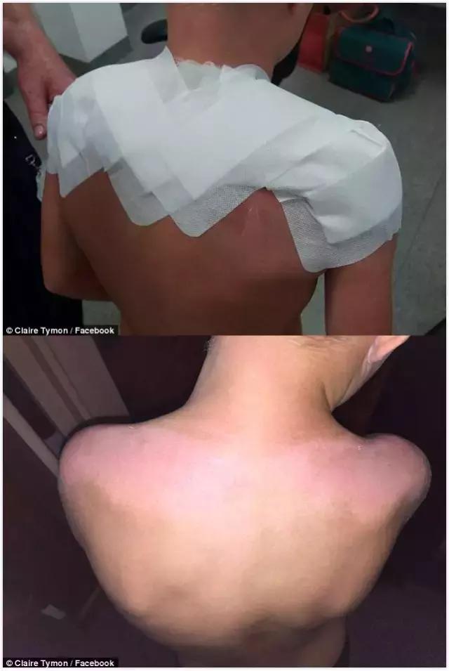 宝宝涂了防晒霜可以防晒几个小时,儿童晒伤防晒霜