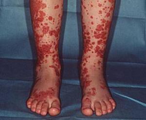 过敏性紫癜是什么症状图片大全,血管脆弱和过敏性紫癜症状一样吗