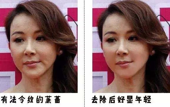 爱笑的人会有属于自己的法令纹,天生法令纹就很深怎么办又不爱笑
