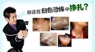 你还在白斑恐吓中挣扎？中医支出这5招，用过的人都点赞！