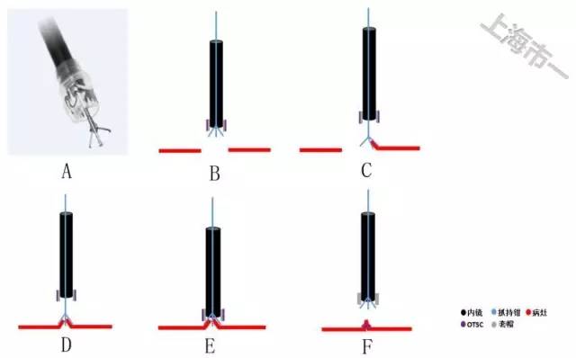 消化道穿孔诊治新进展,消化道穿孔内镜表现