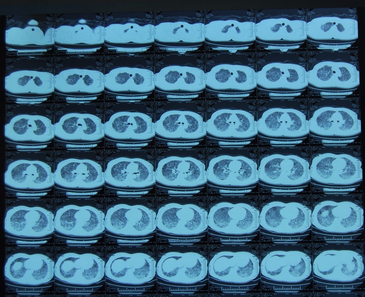 喘息、呼衰1年，问病史才发现是这个病！