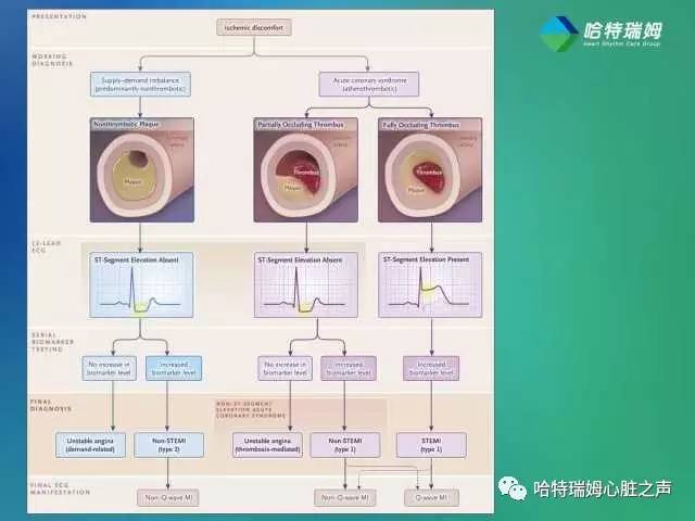 关于“急性心肌梗死”的科普,心肌梗死临床指南最新