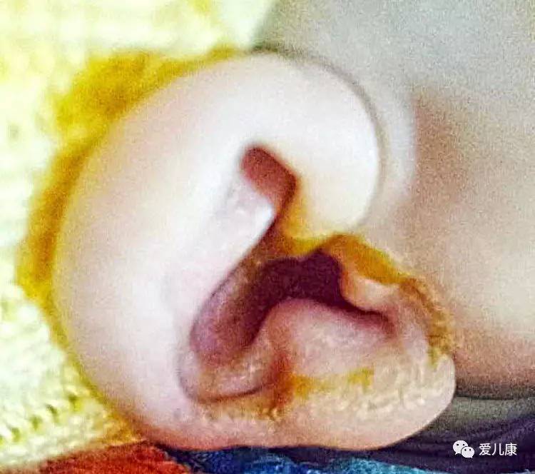 宝宝耳朵里流黄水照片,宝宝耳朵流黄色液体一般咋检查