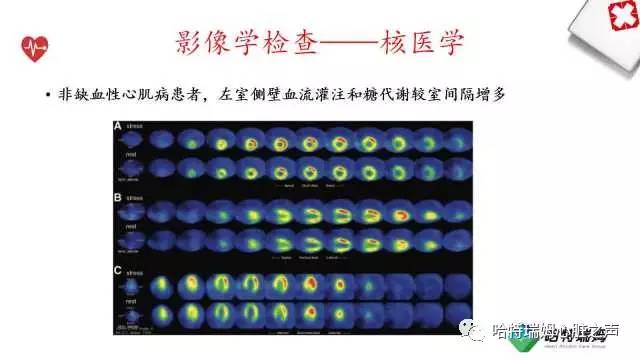 「心声」从机制到临床，一起认识左束支阻滞！