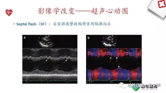 「心声」从机制到临床，一起认识左束支阻滞！