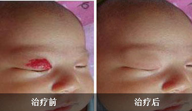 2个月宝宝眼皮血管瘤建议治疗吗,2个月大的宝宝血管瘤要不要治疗