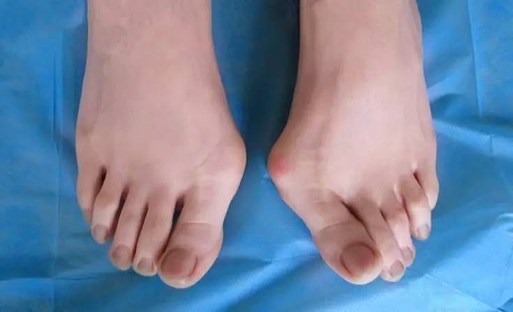 拇外翻大脚骨俗称叫什么,拇大脚骨外翻图片