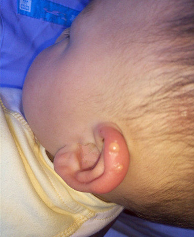 婴儿被蚊子叮咬起水泡需要处理吗,婴儿被蚊子叮咬后红肿硬起小水泡