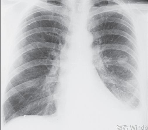 类风湿性关节炎的护理措施,类风湿性关节炎如何保护关节功能