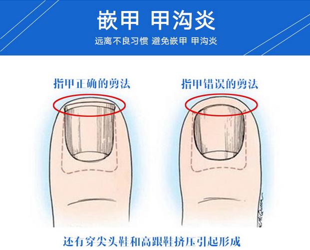 脚趾甲长肉里？不拔甲，1招帮你轻松治！