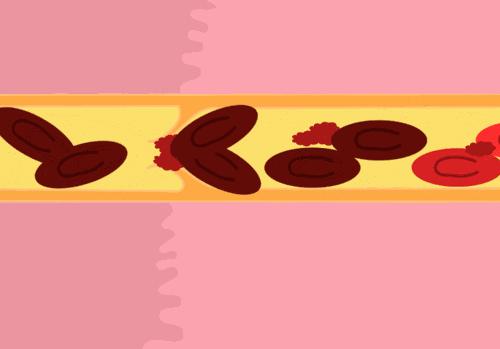 血管淤堵吃红豆能疏通血管吗,血管最怕堵一碗汤让血管干净如新