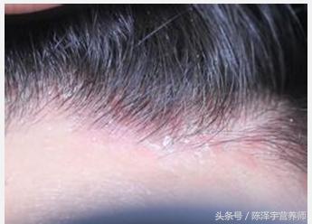 烟酸缺乏会有哪些症状,烟酸缺乏可引起什么