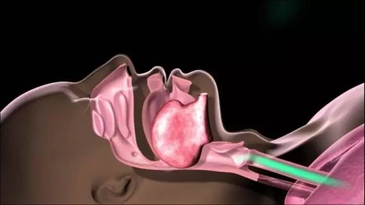 宁波的朋友打呼噜视频,失眠睡不着觉的朋友们看过来
