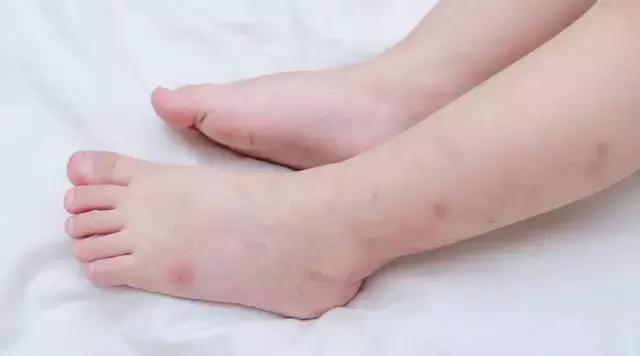 夏天身上总是各种「包」，对症下药，还你滑嫩肌肤！