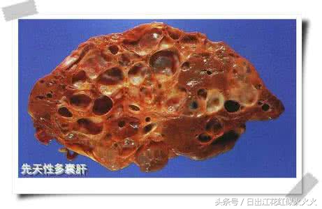 治疗多囊肝的成功案例,肝脏保健与调养论文