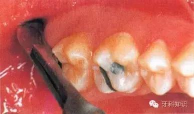 口腔拔牙图片,口腔拔牙麻醉多久消退