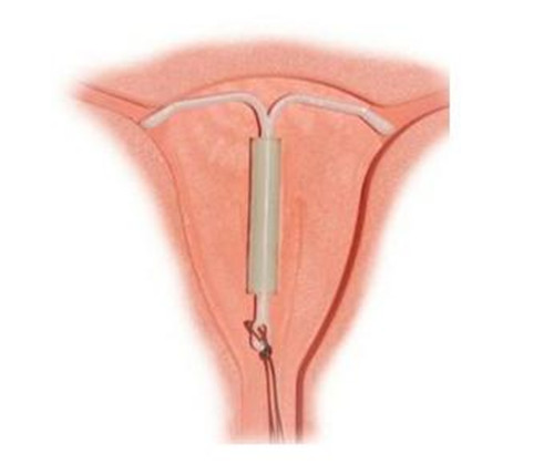 节育环真的万恶不赦吗,节育环放置不当会有哪些危害