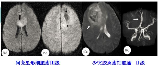 医学干货：瘤样炎性脱髓鞘病与胶质瘤、PCNSL临床、影像鉴别