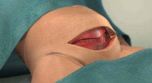 给孩子看的剖腹产手术全部流程,剖腹产手术最详细的介绍