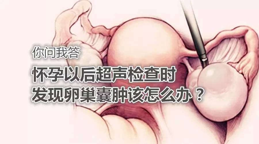 怀孕发现有5cm卵巢囊肿不疼怎么办,孕期有恶性卵巢囊肿有什么影响吗