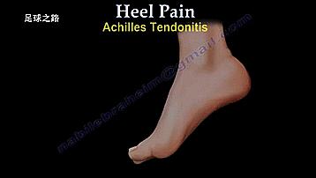 足跟痛最常见病因,足跟痛警惕四种疾病