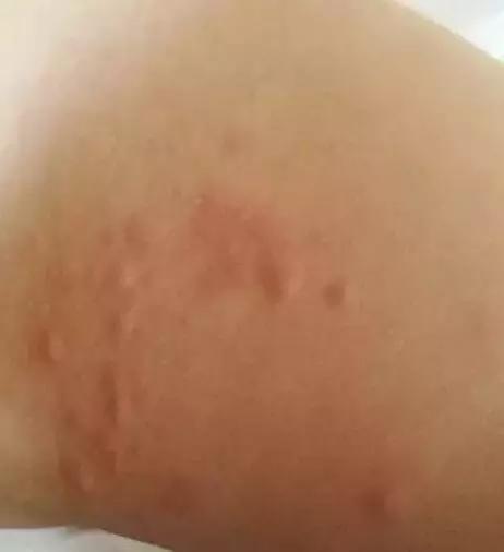 夏天身上总是各种「包」，对症下药，还你滑嫩肌肤！