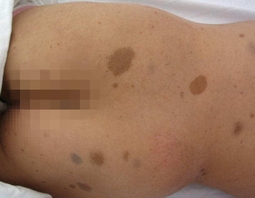 胎记表面粗糙像结痂,胎记表面有小疙瘩