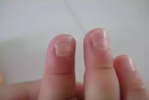 指甲整个掉了需要注意哪些,小孩的指甲应该怎么处理