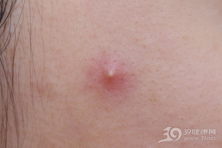 青春痘特别严重的一个治疗方法,比较严重的青春痘要怎么治