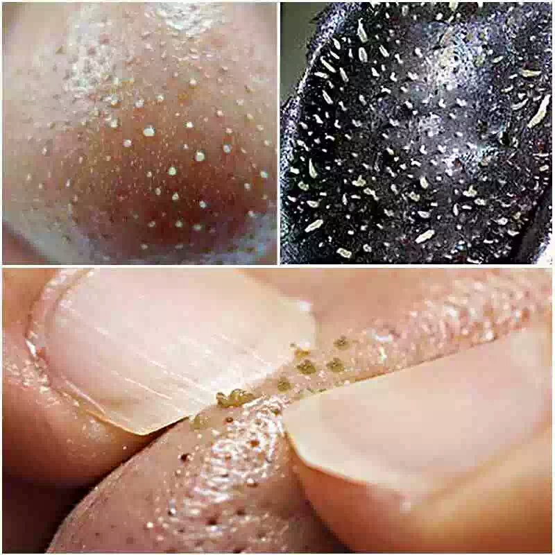 教你去黑头小妙招方法简单效果好,怎么用黑头针去除黑头