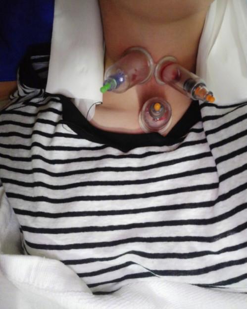 杨幂放血治感冒吗,神奇的中医辨证治疗