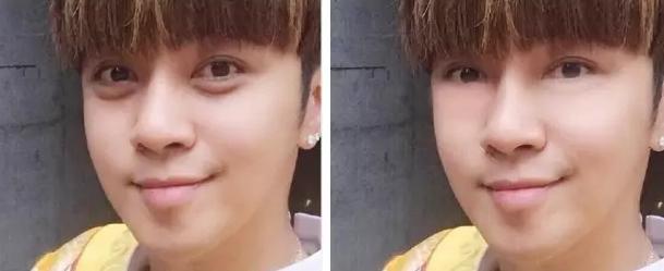 切除眼袋是唯一解决眼袋的方法,眼袋切除方法有哪些