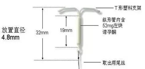 节育环中的爱马仕,节育环曼月乐副作用
