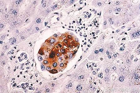 治疗癌症新技术转基因,自体干细胞治疗癌症