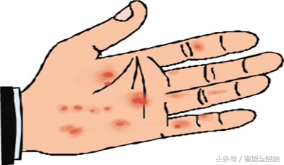 大人手上起了一个大水泡要当心了,手上起密密麻麻的小水泡是怎么了