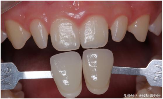 打桩后做的全瓷牙寿命是多久,韩国奥齿泰全瓷牙一般寿命多少年