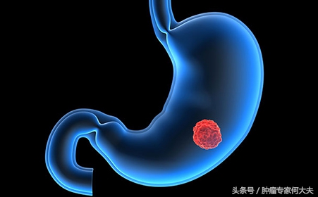 早期胃癌术后复发转移到肺脏,胃癌复发腹膜转移用靶向治疗好吗