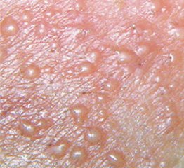 std性传染病,什么支原体感染属于性传播疾病