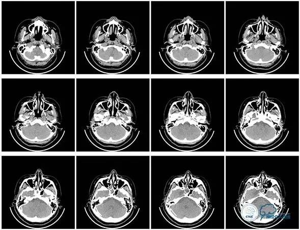 静脉窦狭窄支架植入术,静脉窦狭窄做支架多少钱