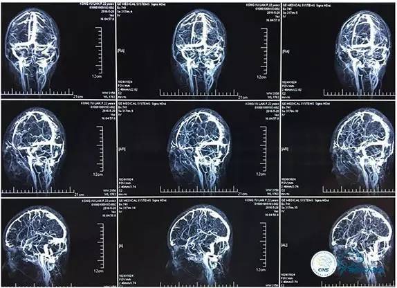 静脉窦狭窄支架植入术,静脉窦狭窄做支架多少钱