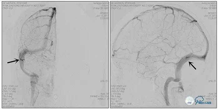 脑静脉窦狭窄做支架危险吗,静脉窦狭窄做支架后多久恢复