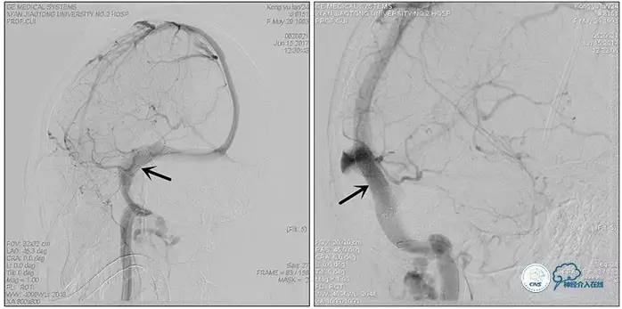 脑静脉窦狭窄做支架危险吗,静脉窦狭窄做支架后多久恢复