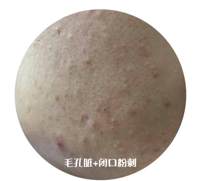 战痘大结局完整版,战痘合集完整版