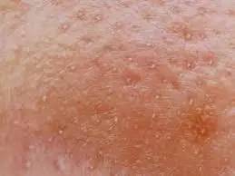 战痘｜史上最全”战痘“解答50+合集！